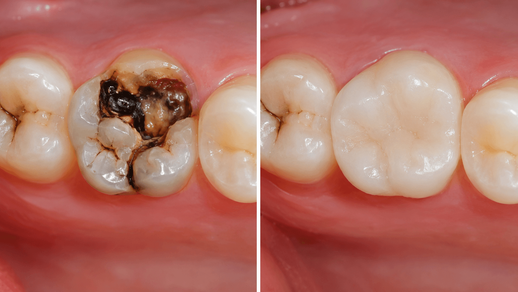Aesthetic Smile Restoration